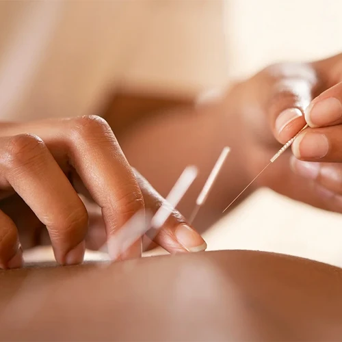 ACUPUNCTURE